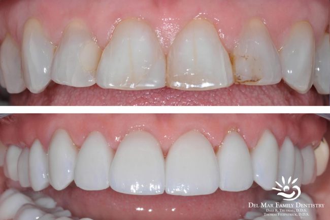 Smile Makeover Before After 2