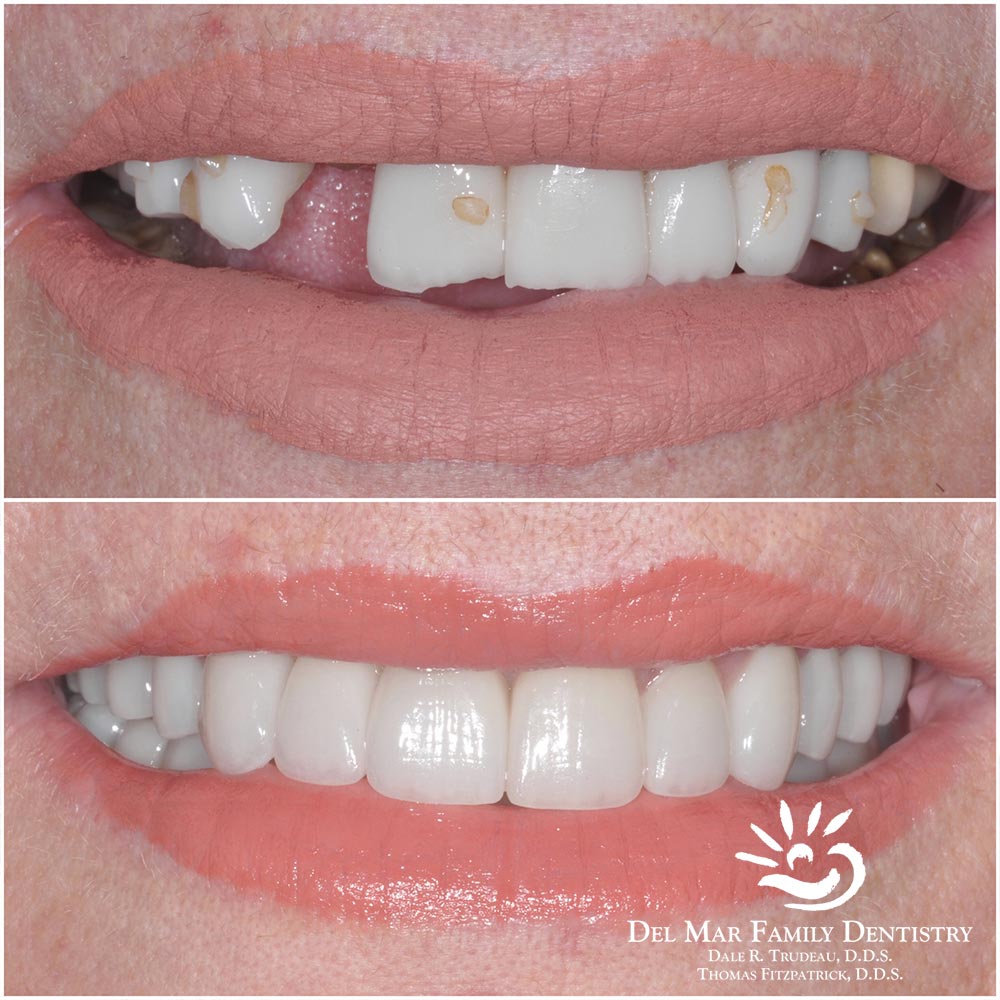 Smile Makeover Before After Image 3