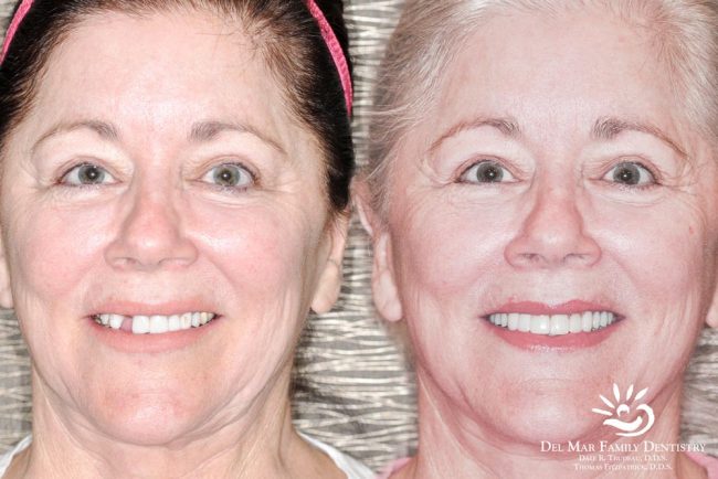Smile Makeover Before After Image